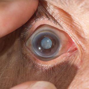 Cataracts